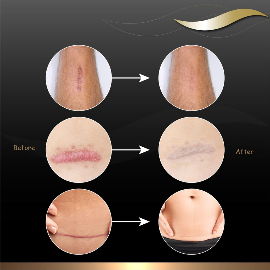 Dermatix Silicone Gel 15 g