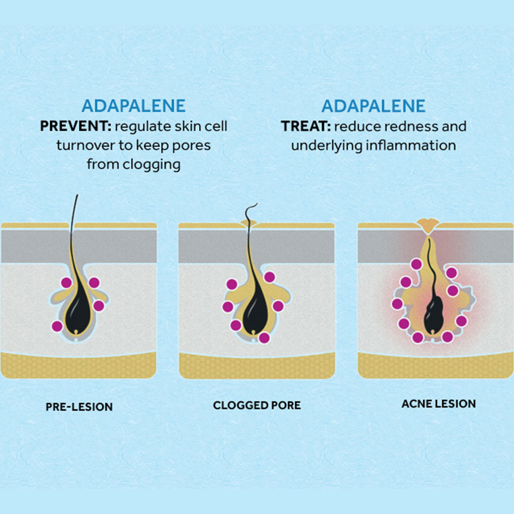 Differin 0.1% Adapalene Cream For Acne 30g