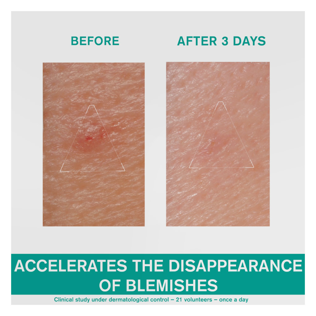 Uriage Hyseac SOS Paste For Spot Control 15g