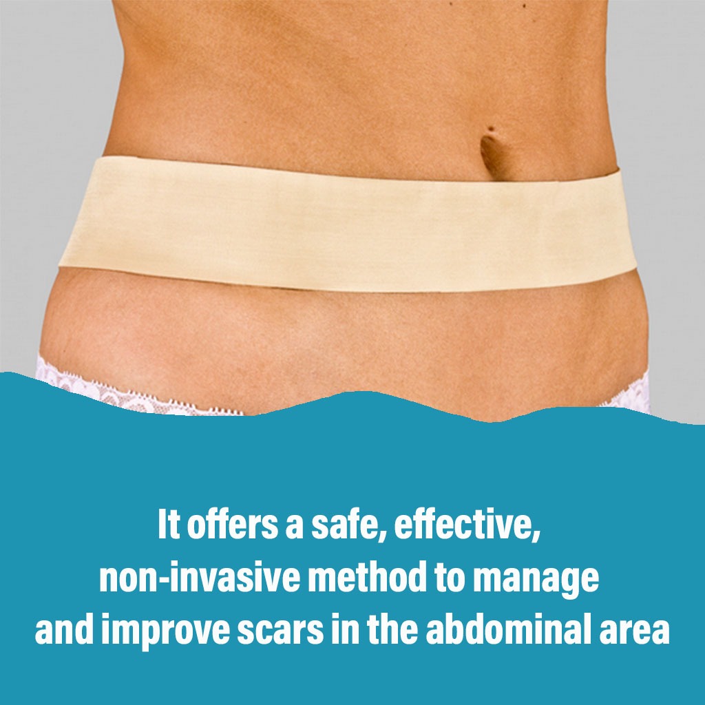 NewGel+ 24" x 2" Abdomen/Extremity Silicone Strip, Beige NG-164, Pack of 1's