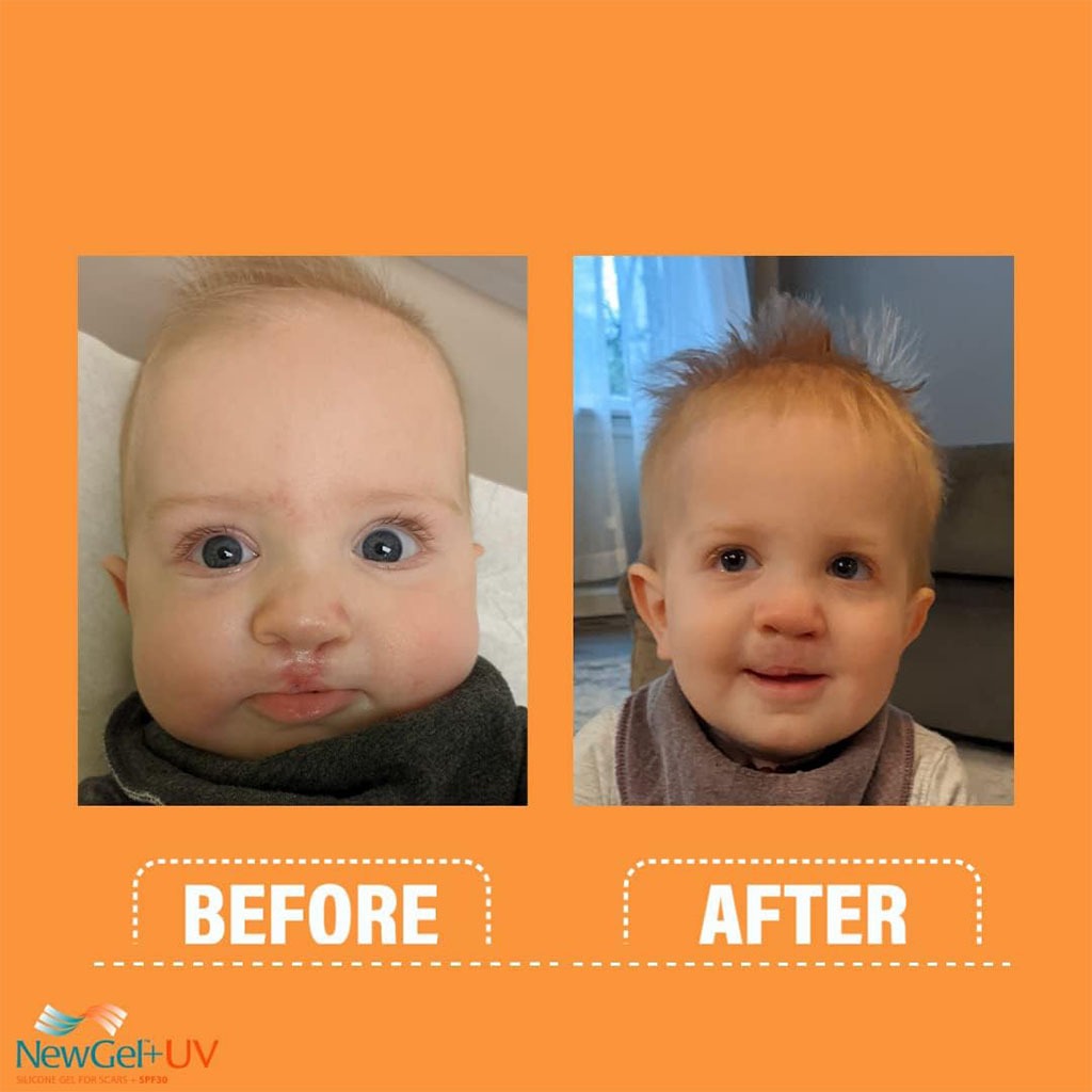 NewGel+UV Advanced Medical-Grade Silicone Scar Gel With SPF 30 15g