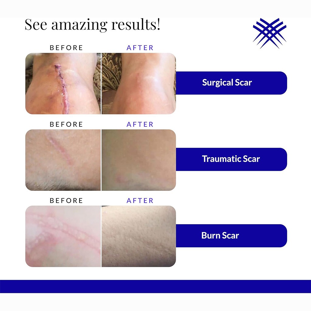 Rejuvasil Silicone Scar Gel 15 mL