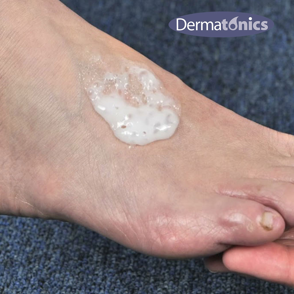 Dermatonics Deodorizing Fizzy Foot Foam With Manuka Honey And Menthol 150ml