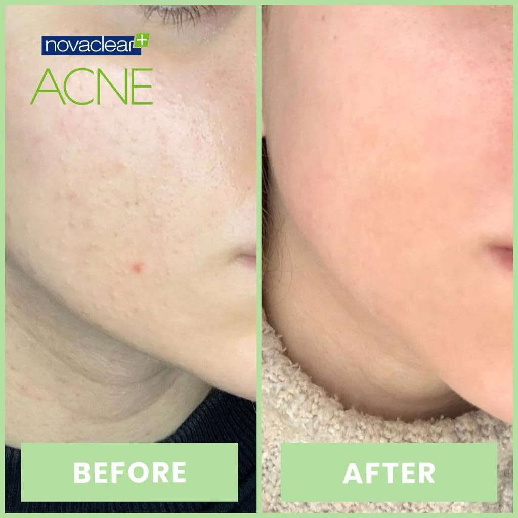 Novaclear Acne Cream With Salicylic Acid For Oily And Acne Prone Skin 40ml