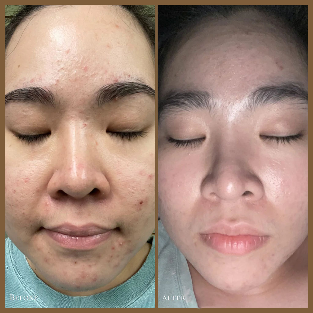 GlowBiotics Probiotic Clarifying Home Peel For Acne With AHA and BHA 15ml