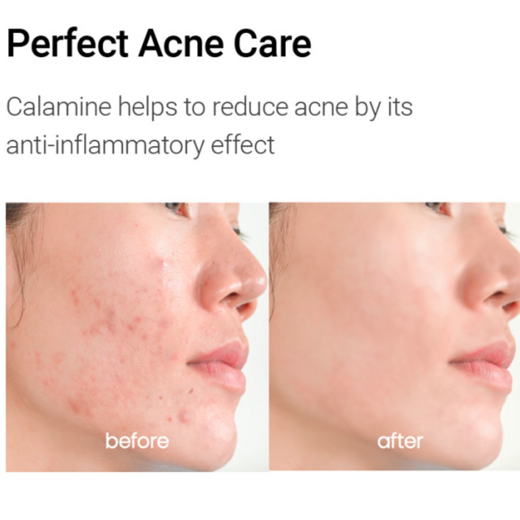 K-Secret Calamine Derma Secret Pink Solution Serum For Oily & Combination Skin Types 50ml