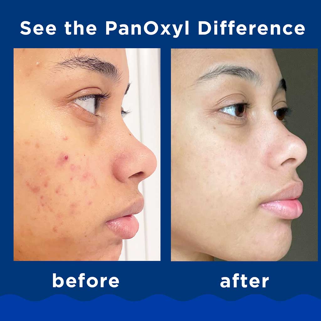 PanOxyl Acne Foaming Face & Body Wash With 10% Benzoyl Peroxide 156g 