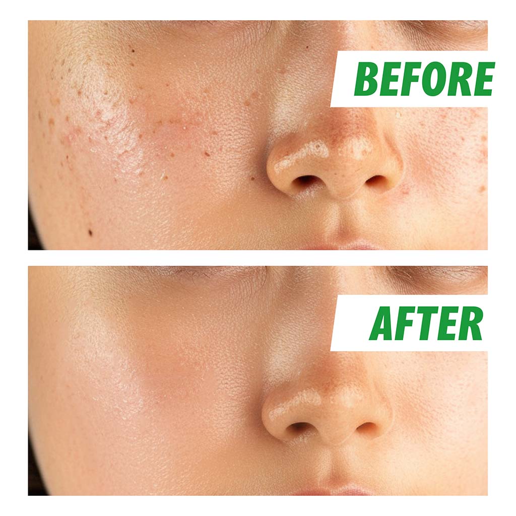 Nightingale Teatamin Facial Treatment Essence Toner For Sensitive Skin 200ml 